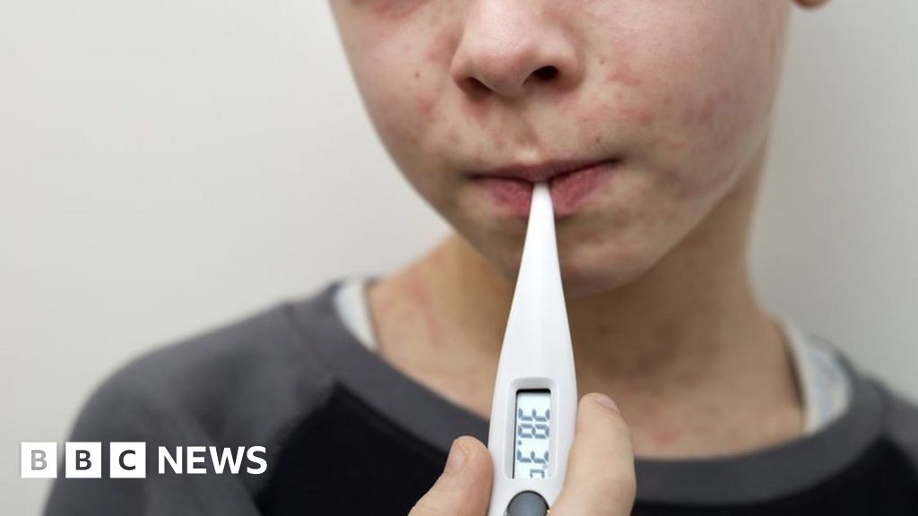 Measles: Why are cases rising and what is the MMR vaccine?